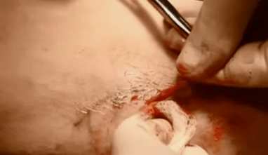 Arten von Operationen zur Entfernung von Krampfadern